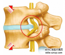 【脊柱】腰突不看年齡，生活習慣是關鍵！