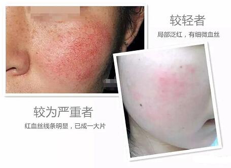 皮脂膜受損