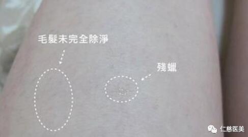 脫毛