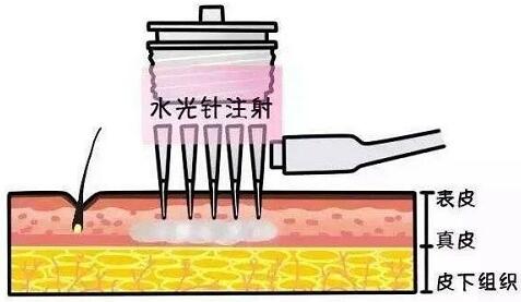 水光針