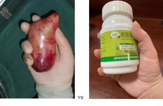 又遇到一個鎖骨下長瘤子的患者，這種病要注意了！
