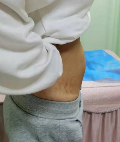 腹直肌分離