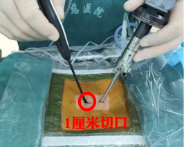 脊柱雙通道內鏡“出手”，1cm微創(chuàng)切口解決腰椎間盤突出癥